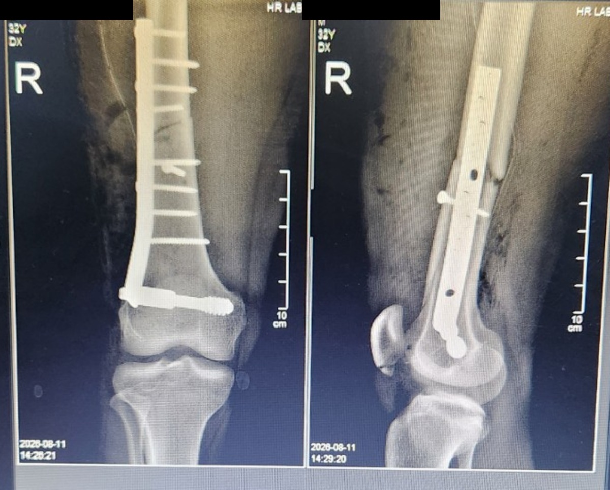 Radiographie postopératoire anonymisée montrant une plaque DCS sur le fémur distal droit